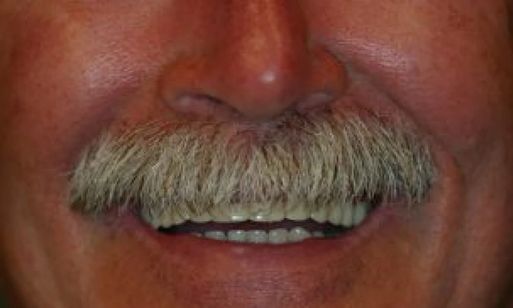 Clinical photo from Ron's dental implant case